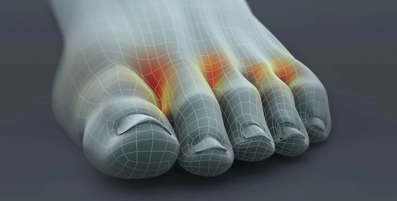 най-често срещаната гъбичка на краката е между пръстите на краката