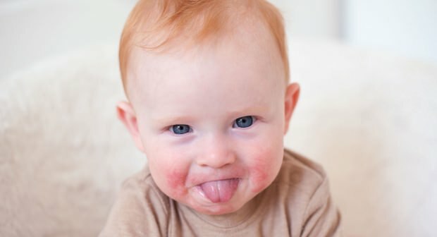 Внимание при бебета с червени бузи! Синдром на плесналата буза и нейните симптоми
