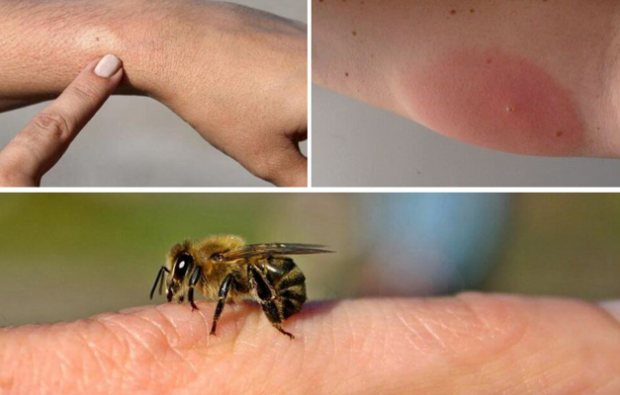симптоми на алергия към пчела