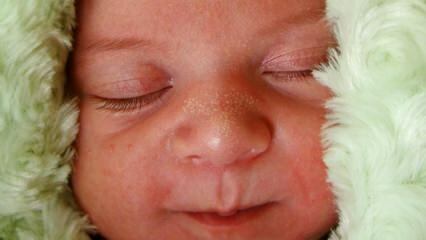 Защо се появяват бели точки при бебета?